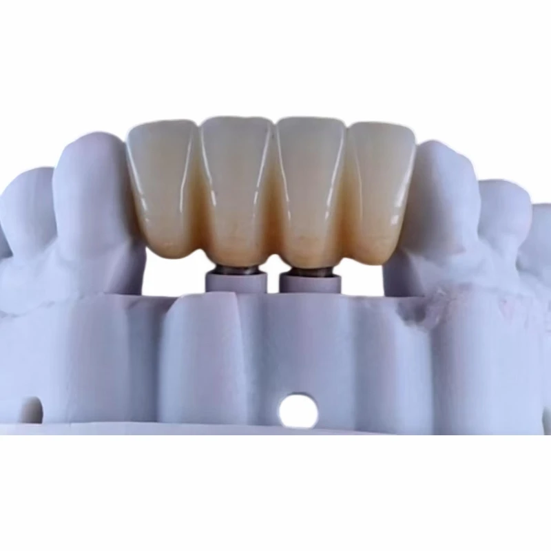 Personalisiertes Titan-Abutment mit Zirkonoxid-Brücke