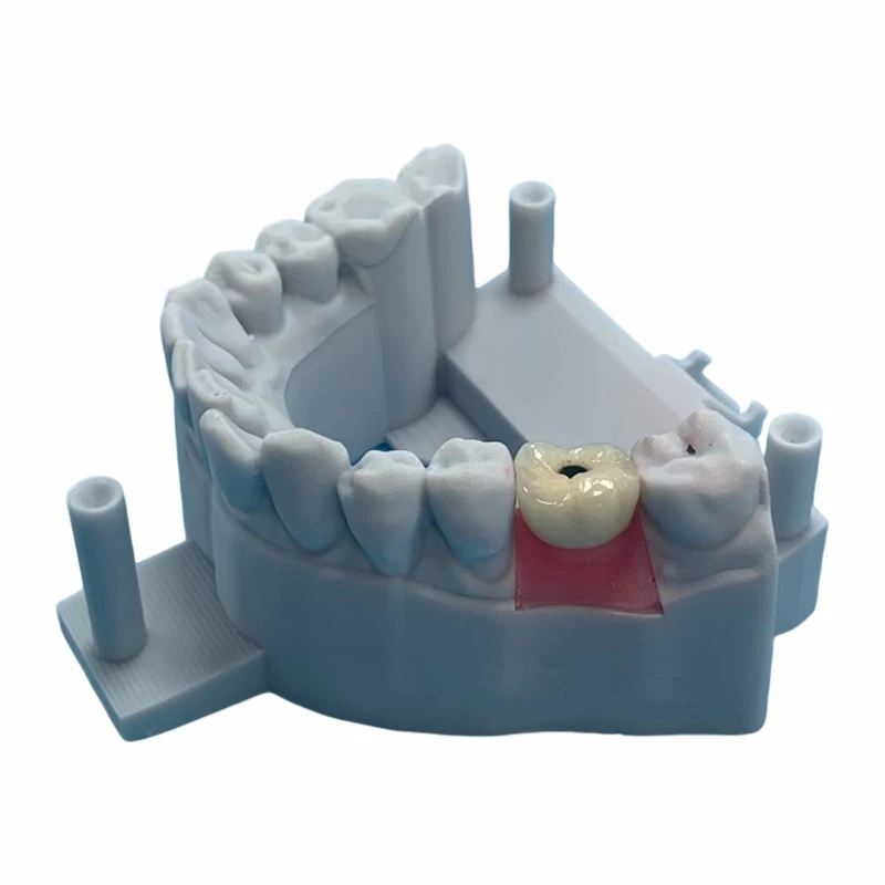 Schraube-Retinierte Implantat-Metallkeramikkrone