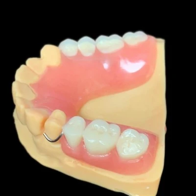 Herausnehmbare Teilprothese mit Drahtverschluss